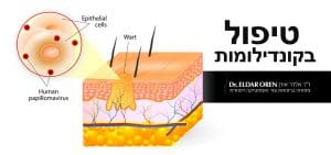 טיפול בקונדילומות